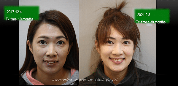 展心展研林口牙醫推薦_矯正案例分享