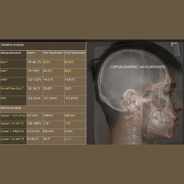 制定矯正治療計畫 - 資料診斷、療程說明