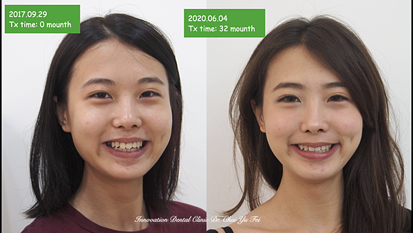 30成人先天缺牙矯正案例