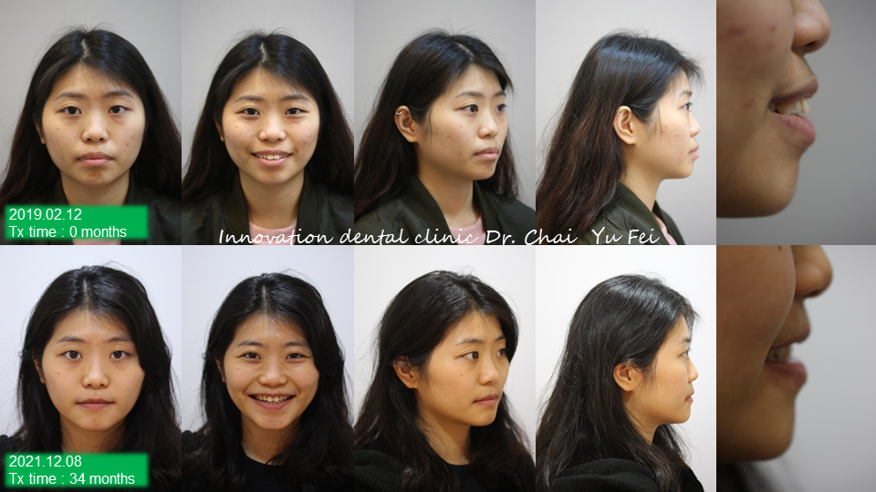 輕微暴牙拔牙矯正前後變化