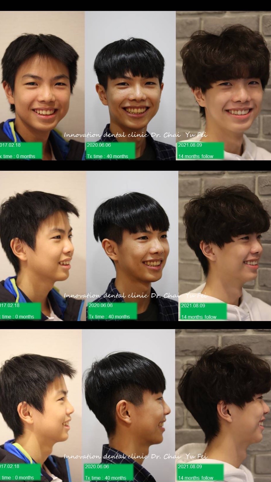 高中生不拔牙矯正案例