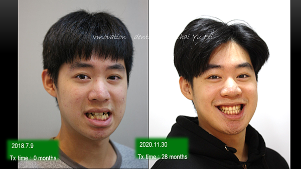 學生齒列擁擠戽斗矯正案例