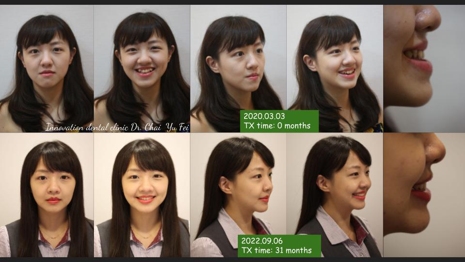 正顎手術案例分享