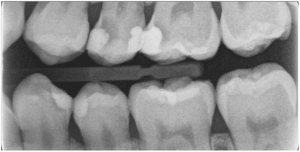 根管活髓保存術