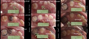 乳牙過早缺失治療