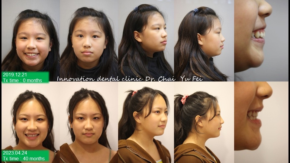 拔牙矯正輪廓改變案例分享