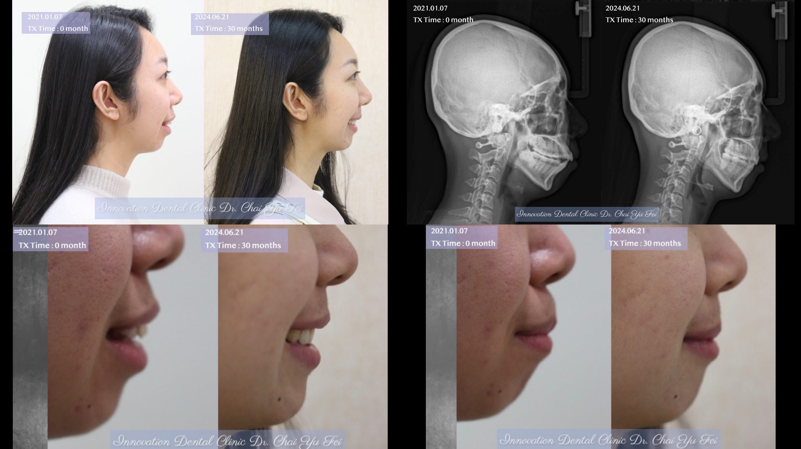 下顎發育不全案例分享