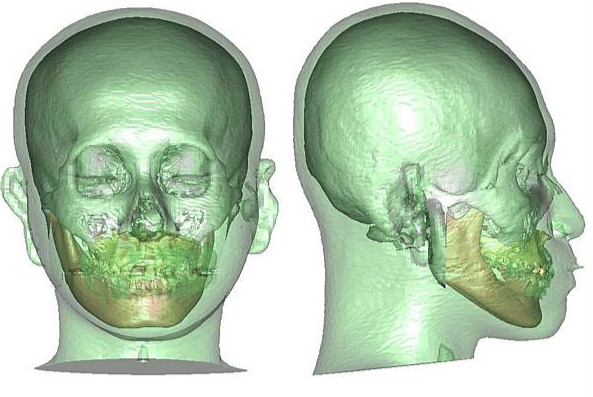 正顎手術原理：藉由移動骨骼，改善臉型與口腔健康
