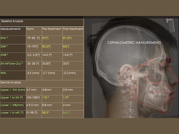 制定矯正治療計畫 - 資料診斷、療程說明
